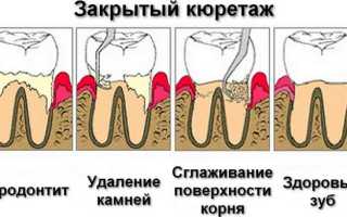 Что такое кюретаж пародонтальных карманов, методы кюретажа