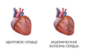 ИБС при беременности