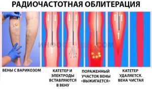 Какие операции проводятся при варикозном расширении вен на ногах?