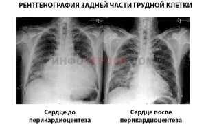 Что такое тампонада сердца и в чем отличие от гемотампонады?