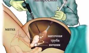 Лапароскопия при беременности: что это такое и как проводится