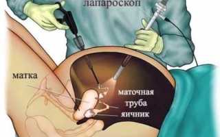 Лапароскопия при беременности: что это такое и как проводится