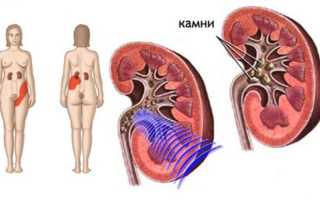 Лечение мочекаменной болезни при беременности