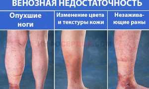 Все про венозную недостаточность нижних конечностей: острую и хроническую
