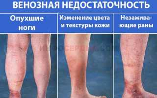 Все про венозную недостаточность нижних конечностей: острую и хроническую