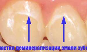 Зубы реагируют на холодное и горячее: причины и что делать