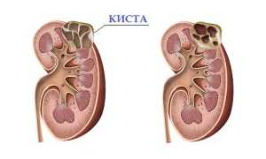 Диета при кисте почки как один из эффективных методов лечения