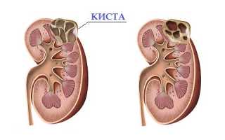 Диета при кисте почки как один из эффективных методов лечения