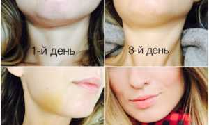 Опухла щека: причины отека щеки, как снять опухоль, раздуло щеку без зубной боли