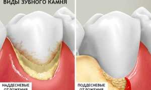 Как очистить зубы от камня: народные и профессиональные методы