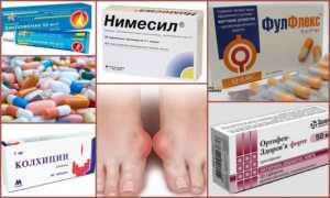 Топ самых эффективных лекарств от подагры — списки препаратов для снятия приступа и выведения мочевой кислоты из организма