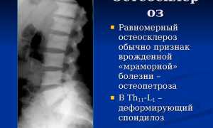 Остеосклероз — что это такое и как его лечить?
