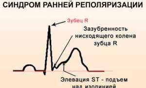 Все о синдроме ранней реполяризации желудочков