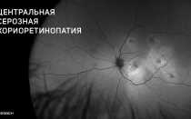Отслоение сетчатки у детей – как лечить?