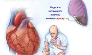 Последствия совмещения Фуросемида и алкоголя