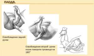 Роды при тазовом предлежании плода