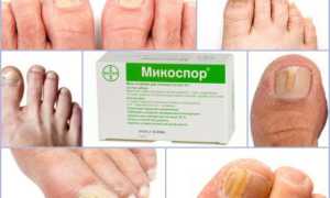 Набор Микоспор для лечения ногтей