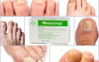 Набор Микоспор для лечения ногтей