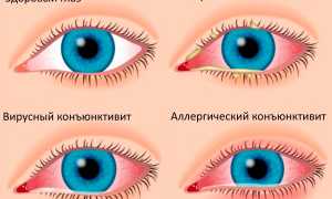 Конъюнктивит во время беременности