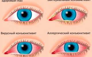 Конъюнктивит во время беременности