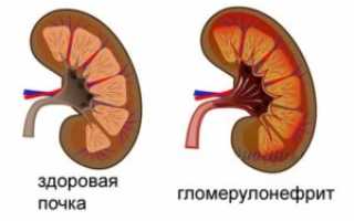 Как делают изотопную ренографию почек