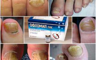 Офломил лак от грибка ногтей
