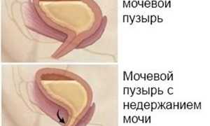 Симптомы и лечение недержания мочи при цистите