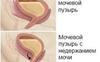 Симптомы и лечение недержания мочи при цистите