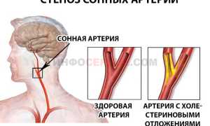 Чем опасен стеноз сонных артерий?