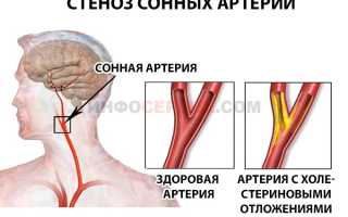 Чем опасен стеноз сонных артерий?