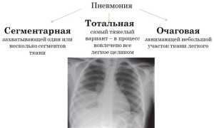 Сегментарная пневмония: этиология, проявления, диагностика, лечение