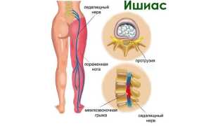Как побороть ишиас при беременности