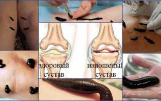 Пиявки при артрозе коленного сустава