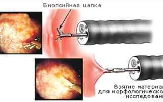 Для чего назначается и какие результаты дает ФГДС с биопсией — подготовка и последствия процедуры