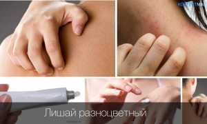 Лечение лишая при беременности