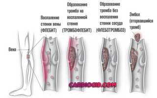 Чем отличается тромбоз от тромбофлебита и флеботромбоза?