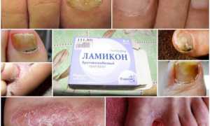 Ламикон (спрей, крем, таблетки) от грибка