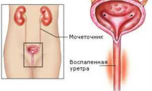 Уретрит у женщин – основные причины, проявления и лечение