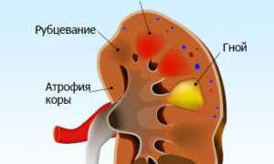 Опасность осложнений при пиелонефрите: последствия и прогноз