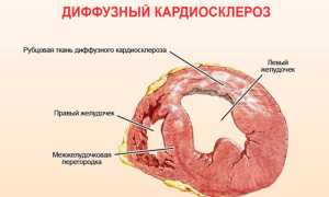 Что провоцирует развитие диффузного кардиосклероза?