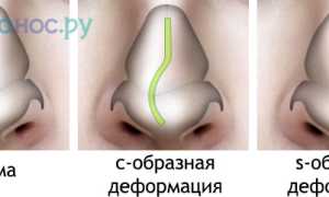 Искривление перегородки носа: причины, последствия, операция