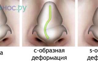 Искривление перегородки носа: причины, последствия, операция