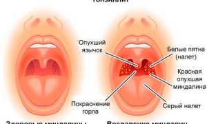 Лечение острого и хронического тонзиллита в домашних условиях народными средствами
