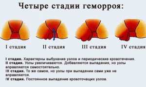 Причины острой, тянущей боли в паху у мужчин