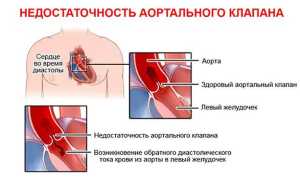 Что такое недостаточность аортального клапана?