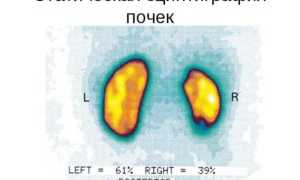 Сцинтиграфия — самый информативный метод исследования почек
