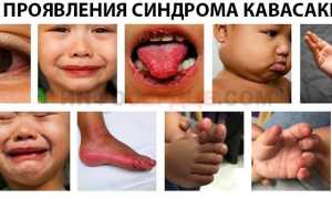 Чем обусловлено развитие синдрома Кавасаки у детей?
