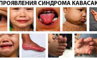 Чем обусловлено развитие синдрома Кавасаки у детей?