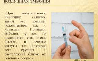 Признаки воздушной эмболии и методы ее лечения
