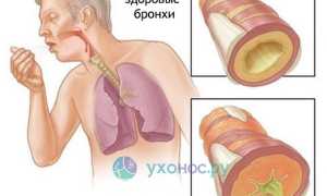 Кашель: как развивается, причины, разновидности и проявления, как лечить